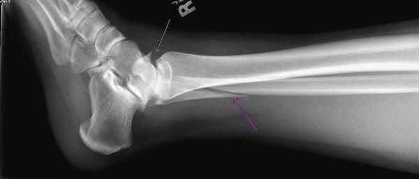 Araştırmacılar, simülasyonu yaratmak için bacağın farklı bölgelerinden pek çok röntgen görüntüsü aldı ve bunlar üzerinde çalıştı.
