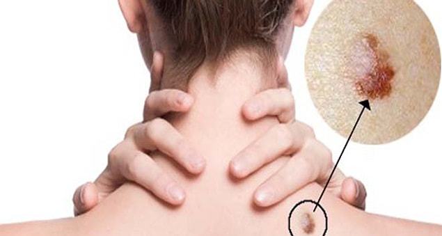 Diyelim ki HPV'yi kapmışsınız bir kere! Sakin olun, dünyanın sonu değil!
