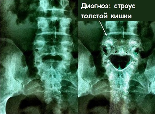 9. В вашей толстой кишке спрятался страус