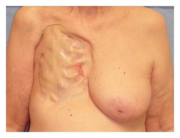 7. Küçük göğüslü kadınların kanser riski daha azdır.