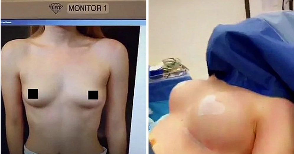 Пластический хирург публикует в Snapchat груди оперируемых пациенток