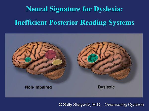 Disleksik bireyler dili kavramak için beyinlerinin sadece sağ kısmını kullanırken disleksik olmayan bireyler beyinlerinin sol kısmının üç bölgesini kullanır.