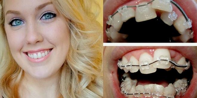 Diş Telleriyle İlgili Çoğumuzun Doğru Sandığı 15 Yanlış Düşünce