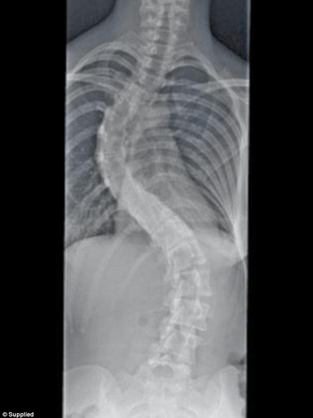 ‘I didn’t have any pain, I didn’t have any symptoms,’ Vanessa says about her scoliosis.