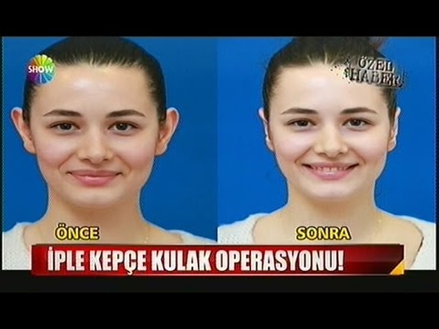 10. İple kepçe kulak estetiği
