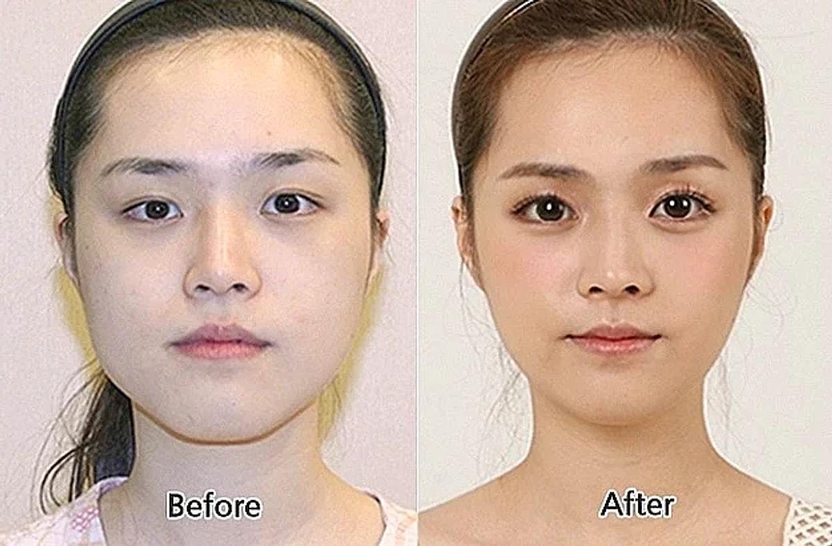 Отличие азиатов. Пластика разреза глаз. ОПЕРАЦИЯМПО увеличению глаз. Кореянки до и после операции на глаза.