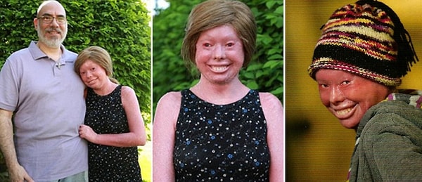 11. Хантер Стейниц - редкое заболевание кожи