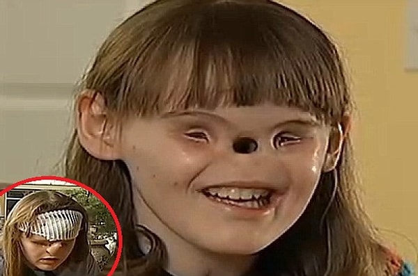 22. Кэссиди Хупер - девочка, родившаяся без носа и без глаз
