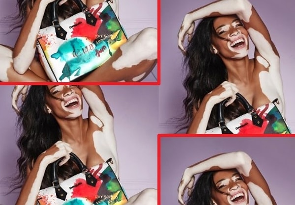 24. Винни Харлоу - модель с редким заболеванием кожи