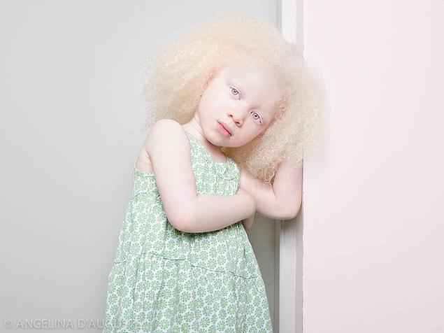 2. Albino Girl