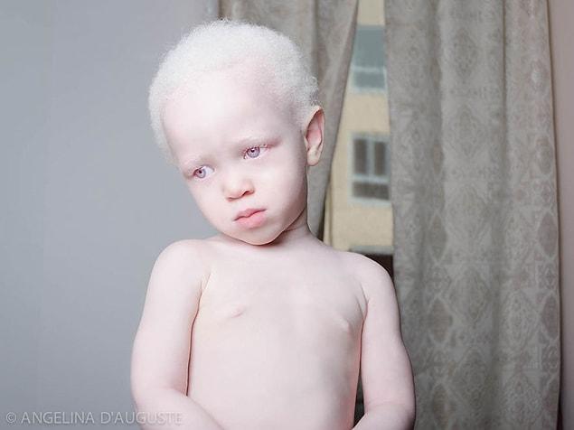 6. Albino Boy
