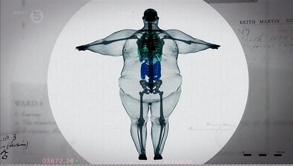 Her yıl dünyada 2.6 milyon kişi obeziteden dolayı hayatını kaybediyor...