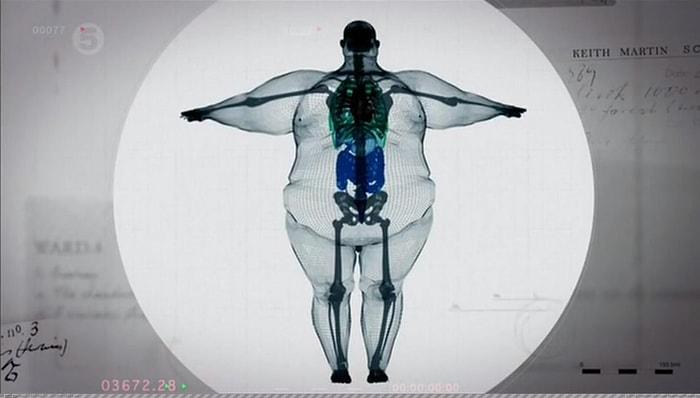 Dersimiz Obezite: Dünya Şişmanlıyor ve Biz Durumu En Kötü 10 Ülke Arasındayız!