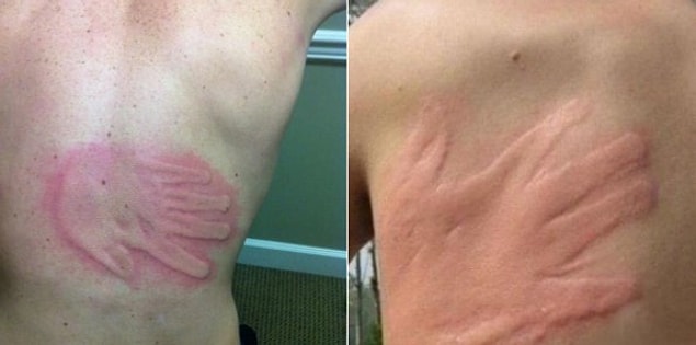 11. They leave scars for life!
