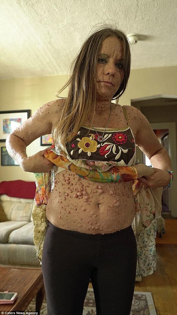 Indiana, ABD'de yaşayan 44 yaşındaki Libby Huffer nadir görülen bir rahatsızlık olan Nörofibromatozis 1'den muzdarip.
