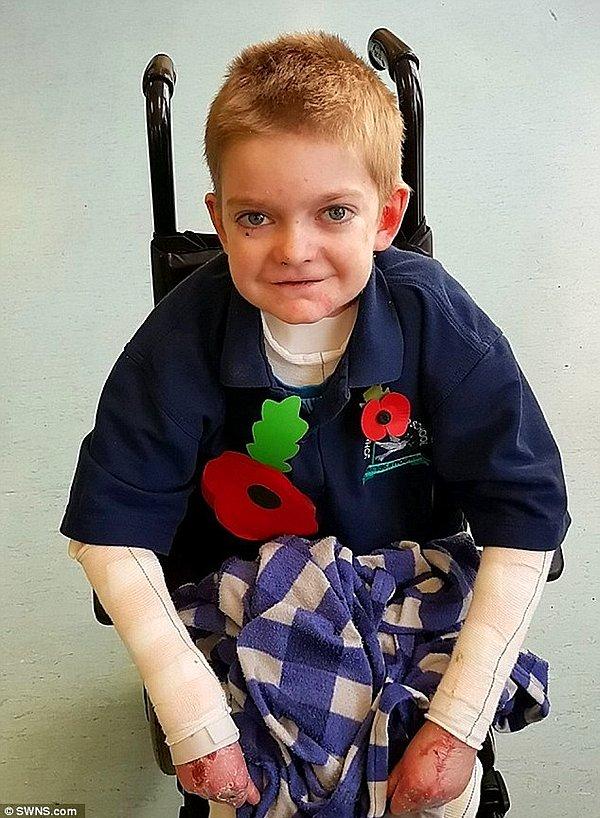 11 yaşınaki Rhys Williams, doğduğu günden beri çok zorlu bir cilt hastalığı ile mücadele veriyor.