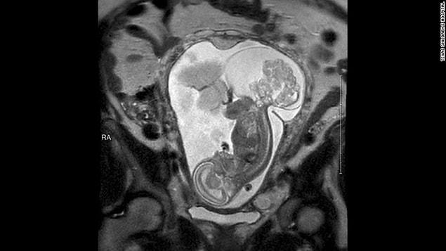 Sacrococcygeal teratoma is a tumor that develops before birth and grows from a baby's coccyx, the tailbone.