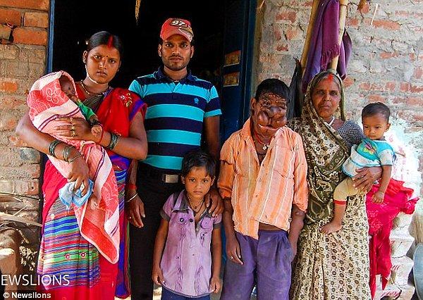 Hindistan'ın Navada şehrinde yaşayan Mithun'un ailesi bir doktorun ona 5 yaşındayken yanlış ilaç vermesi yüzünden kitlelerin vücuduna yayıldığını iddia ediyor.