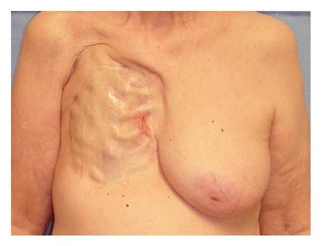 Women with smaller breast have less risk of getting cancer.