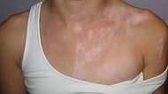 Ciltte Beyaz Lekelerin Oluştuğu, Stres Tarafından Tetiklenen Bir Hastalık: Vitiligo
