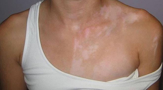Ciltte Beyaz Lekelerin Oluştuğu, Stres Tarafından Tetiklenen Bir Hastalık: Vitiligo