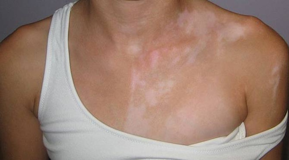 Ciltte Beyaz Lekelerin Oluştuğu, Stres Tarafından Tetiklenen Bir Hastalık: Vitiligo