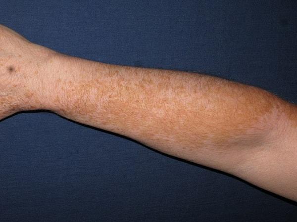 Peki bağışıklık sistemi neden melanin pigmentlerine saldırıyor, yani vitiligonun nedeni ne?