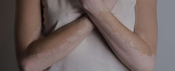 Vitiligo hastalığına sahip olan kişilerin bir kısmı, belirtileri genellikle 10 ila 30 yaşları arasında gösteriyor.