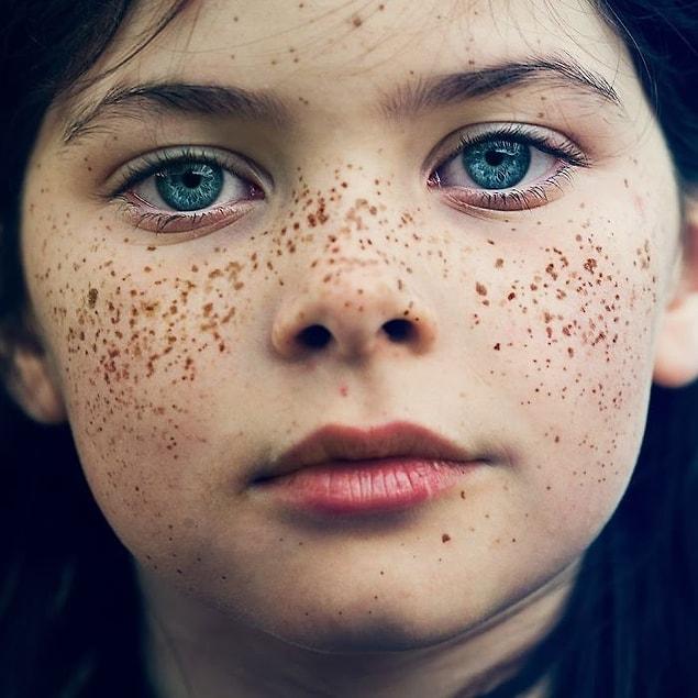 13. There are different types and shapes of freckles...