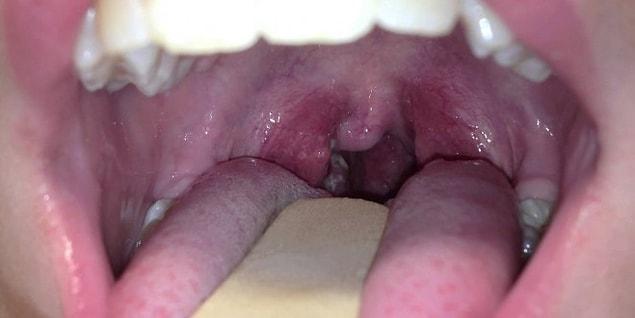 12. Tonsillitis