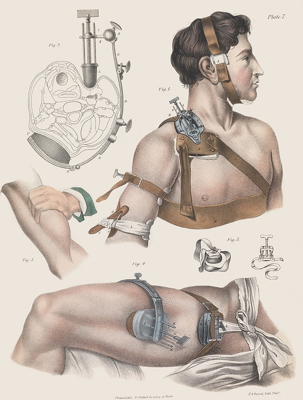 7. Сжатие артерий руки и ноги, для уменьшения потери крови во время операции