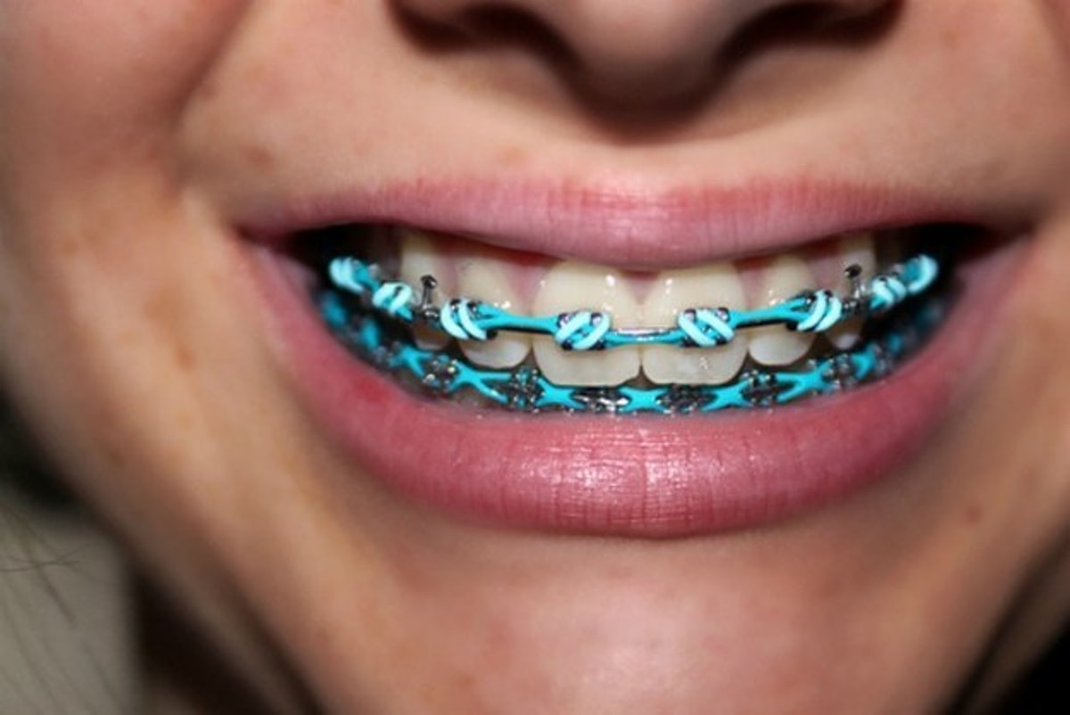 Цепь на зубы. Эластичная цепочка на брекеты. Разноцветные лигатуры для брекетов. Цветные резинки на брекеты. Цепь на зубы.
