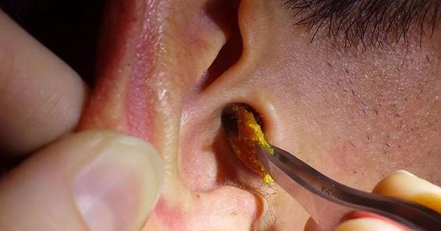 8. Some people have ears with sharp curves that prevent earwax from getting out. That's why it can pile up in the ear canal.