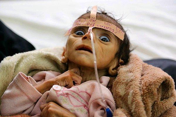 31. Yemen'in Sana kentindeki Al-Sabeen Hastanesi'ne akut beslenme eksikliği ile kaldırılan bebek Udai Faisal bundan 2 gün sonra hayatını kaybetti.