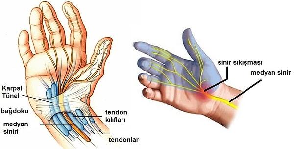 Median sinir, parmakları hareket ettiren diğer tendonlarla beraber, “karpal tünel” denen dar bir boşluk içinden geçer.