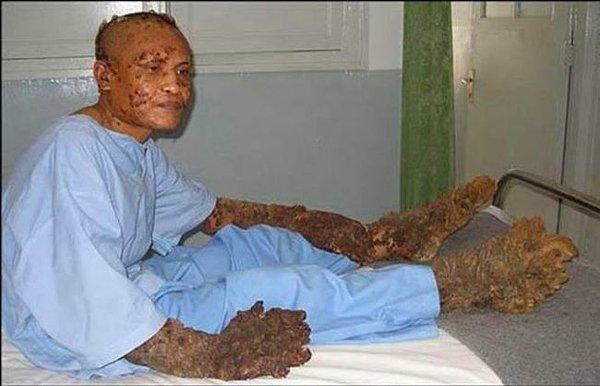 Dokuz ay süren bir dizi ameliyattan sonra Dede'nin ellerindeki ve ayaklarındaki köklerin birçoğu temizlendi.