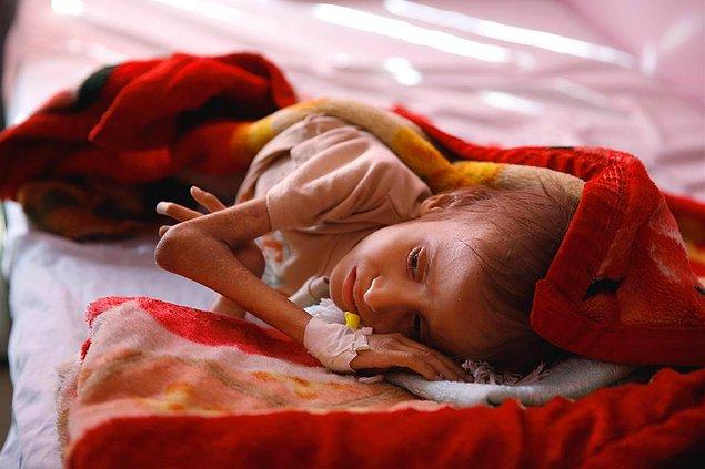 BM geçen ay Yemen'de 1,5 milyon çocuğun açlıkla yüz yüze olduğunu, 370 bininin yetersiz beslenme yüzünden bağışıklık sistemlerinin çöktüğünü duyurmuştu.