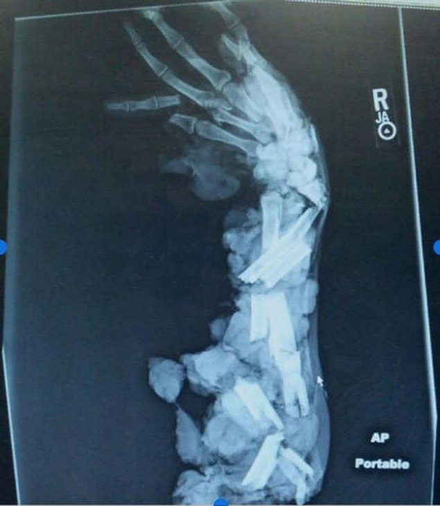 10. Tuz buz olmaya ramak kalmış kol kemiklerinin röntgeni. 😦