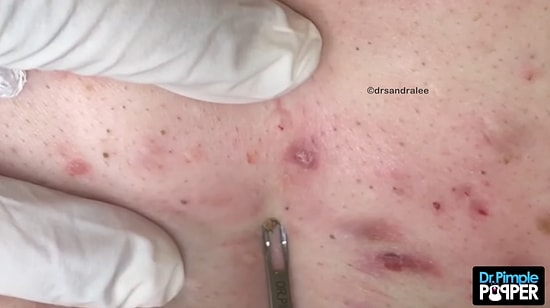 15 Dakika Boyunca Siyah Nokta Temizleyen Doktordan İzlemeyi Sevenlere Hipnoz Etkili Video