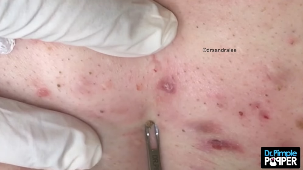 15 Dakika Boyunca Siyah Nokta Temizleyen Doktordan İzlemeyi Sevenlere Hipnoz Etkili Video