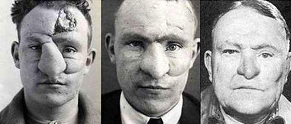 9. World War I Facial Reconstructions