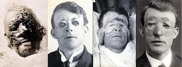 Walter Yeo, Birinci Dünya Savaşı esnasında yüzüne feci yaralar almış.