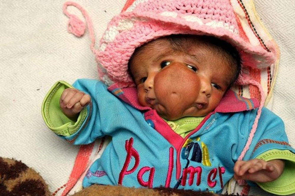 "İki Yüzlülük" Denilince Aklınıza Geleni Değiştirecek Bir Anamoli: Diprosopus