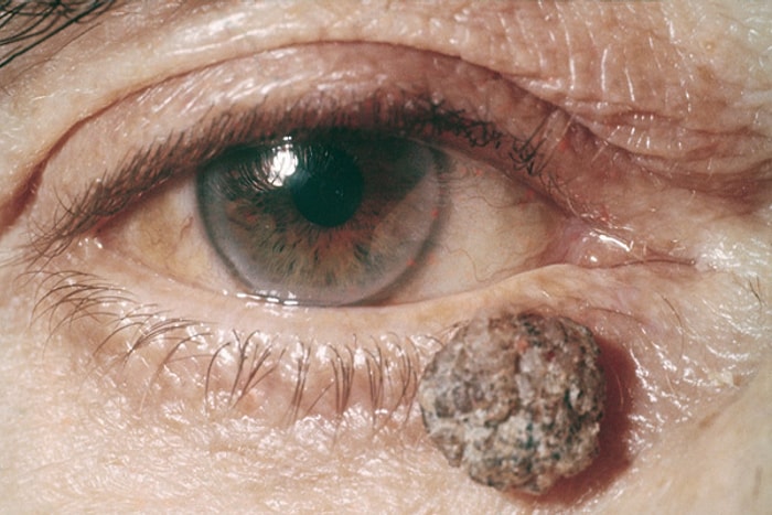 Herkesi En Az Bir Defa Şüpheye Düşürmüş Soru: Ben Yolmak ya da Kanatmak Kanser Yapar mı?