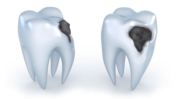 6. Центр зуба состоит из стволовых клеток, но их запаса хватает лишь на то, чтобы восстановить лишь малую часть дентина, и если дупло слишком большое, они не смогут его залечить.