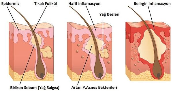1. Sivilceler, yağ bezlerinin cilde kayganlık veren ve korunmasını sağlayan 'sebum' adlı yağı fazla üretmesi ve ölü deri hücrelerinin  gözenekleri tıkaması sonucu oluşur.