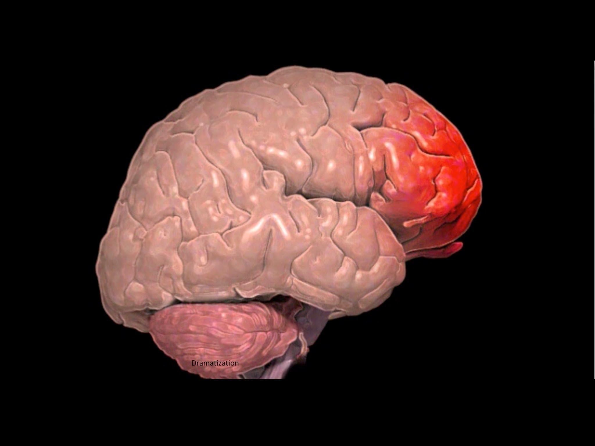 Bu rahatsızlıkta beynin ön bölümünde normalden daha düşük kanlanma ve daha düşük aktivite görülüyor.