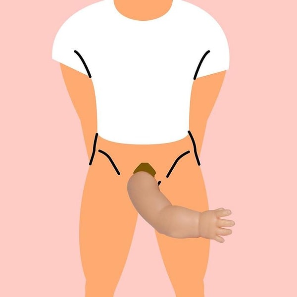 12. Франция — "Bras D'enfant" — Рука младенца