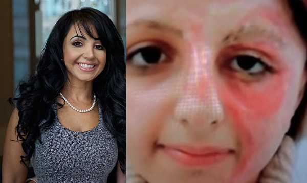 2. Басма Хамид скрывает последствия ожога татуировкой телесного тона