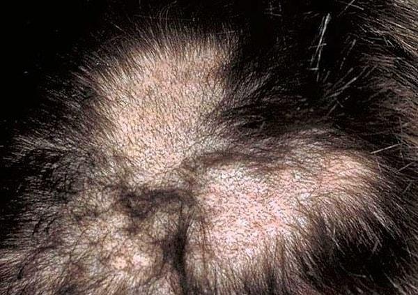 5. Hastalık kaşların, kirpiklerin ve saçların tamamen dökülmesine yol açacak şekilde görülebilir.
